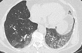 Pour changer de la Covid : un métapneumovirus ! 
