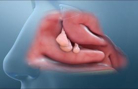 Polypose nasosinusienne : du bilan aux différents traitements