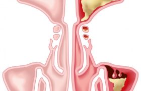 Chirurgie sinusienne :  trucs et astuces 