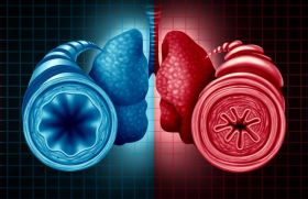 Asthme éosinophique, le benralizumab réduit les bouchons muqueux 