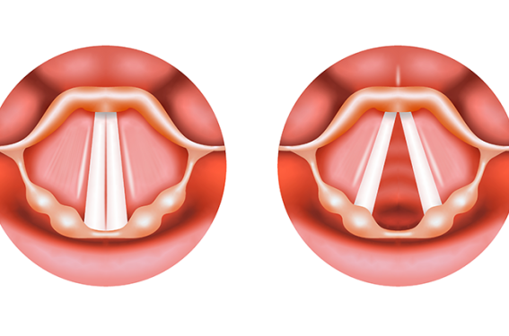 Ne pas confondre dysfonction des cordes vocales et dysfonction respiratoire