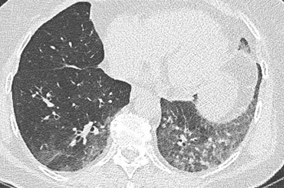 Pour changer de la Covid : un métapneumovirus !