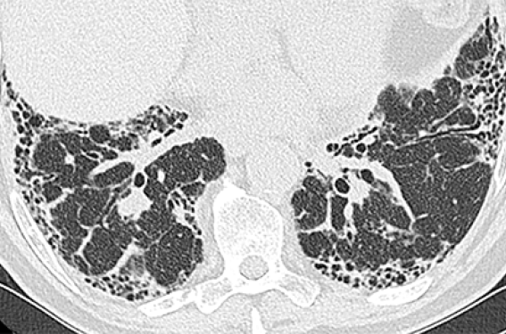 Traitement de la fibrose pulmonaire idiopathique