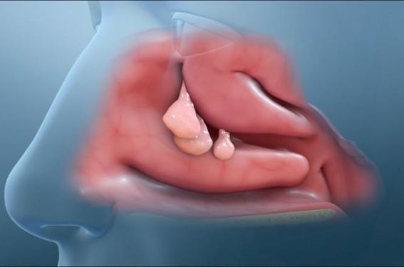 Polypose nasosinusienne : du bilan aux différents traitements