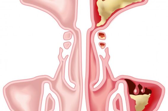 Chirurgie sinusienne : trucs et astuces